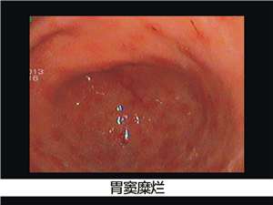 糜烂性胃炎是怎么引起的?