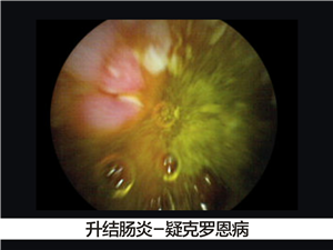 结肠炎的危害有哪些?